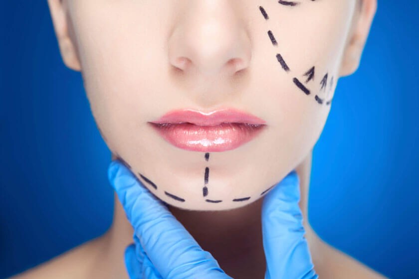 Photo illustration showing facial plastic surgery incisions