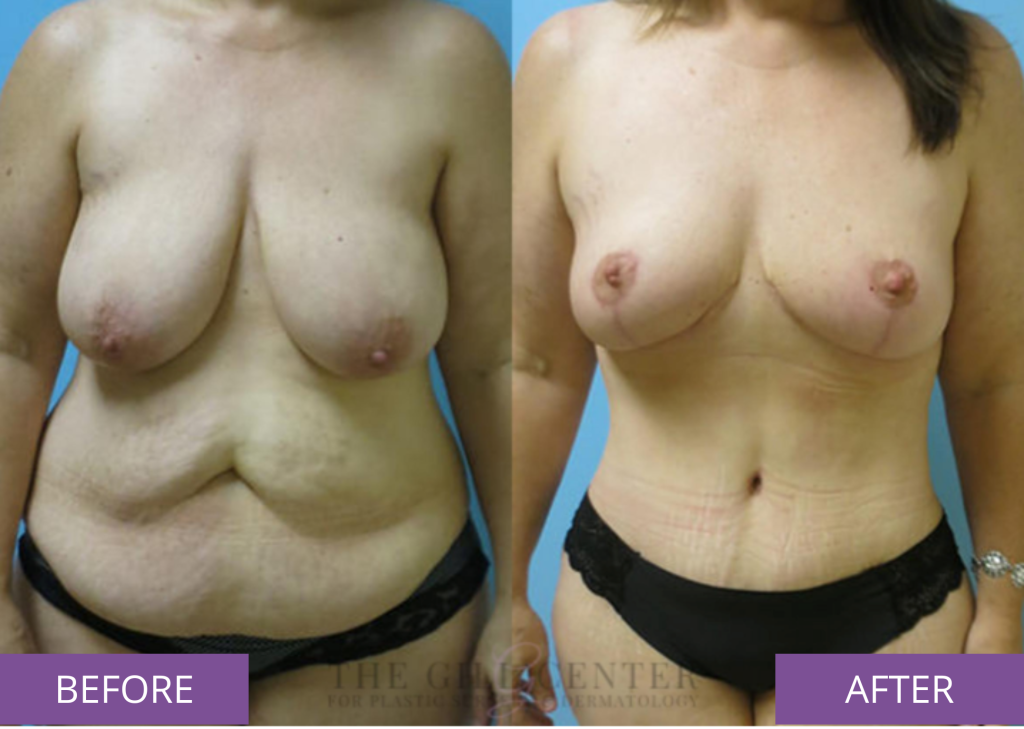 Before and after breast lift and tummy tuck (real patient)