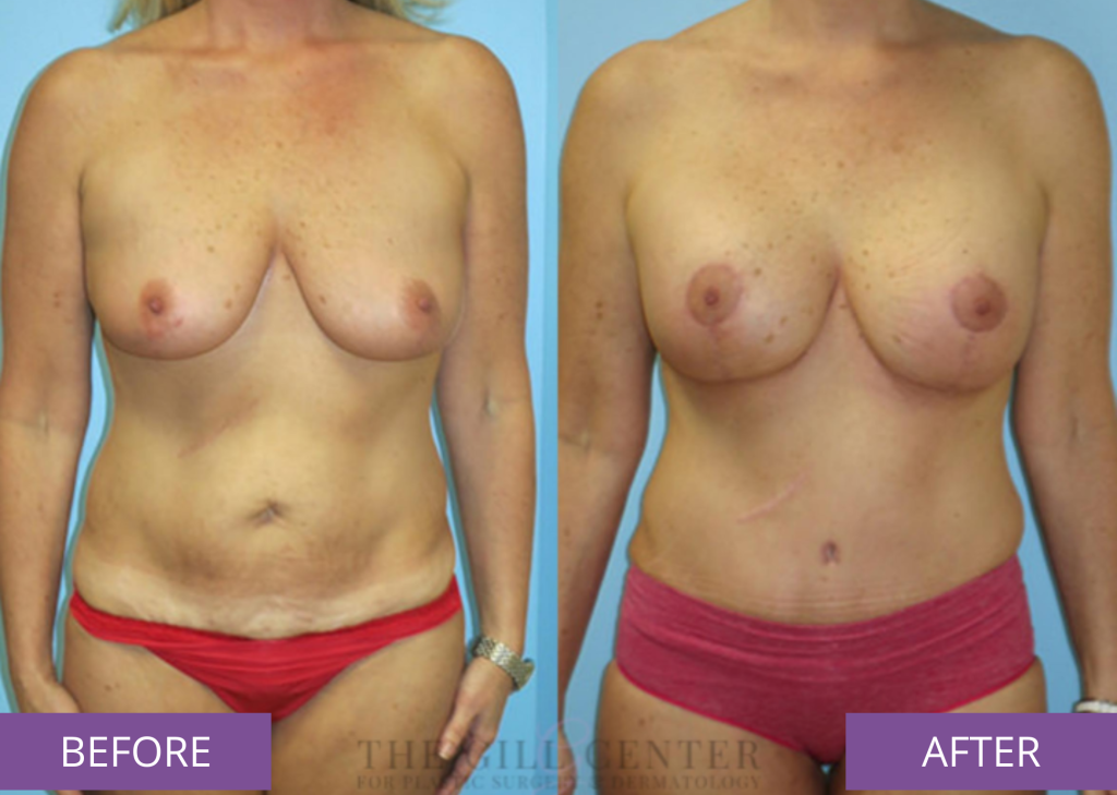 Before and after breast lift and tummy tuck (real patient)